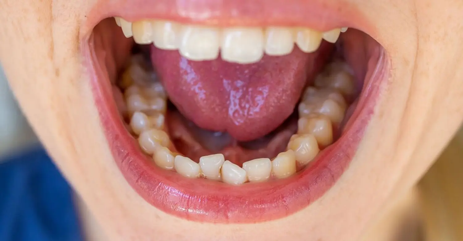 Metallic Taste in Mouth 2